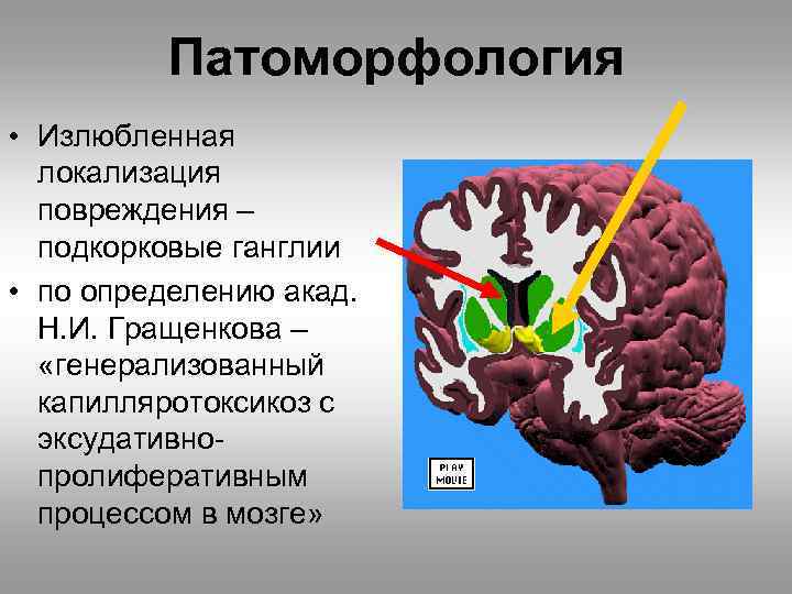 Патоморфология • Излюбленная локализация повреждения – подкорковые ганглии • по определению акад. Н. И.