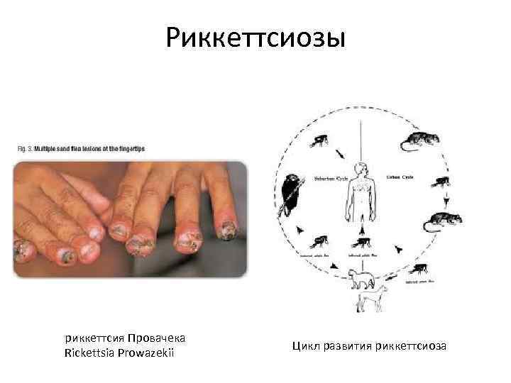 Риккеттсиозы риккеттсия Провачека Rickettsia Prowazekii Цикл развития риккеттсиоза 