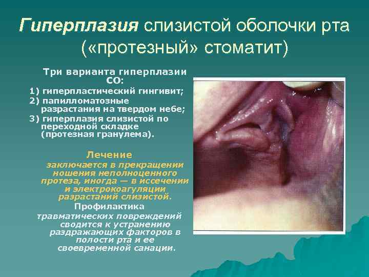 Гиперплазия слизистой оболочки рта ( «протезный» стоматит) Три варианта гиперплазии СО: 1) гиперпластический гингивит;