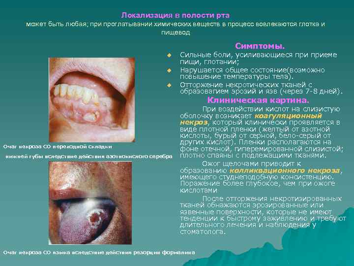 Локализация в полости рта может быть любая; при проглатывании химических веществ в процесс вовлекаются