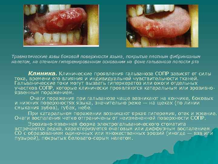Травматические язвы боковой поверхности языка, покрытые плотным фибринозным налетом, на отечном гиперемированном основании на