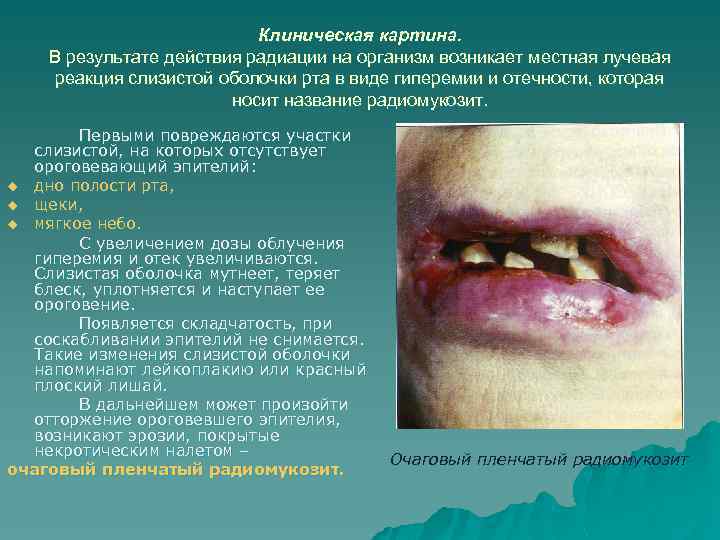 Клиническая картина. В результате действия радиации на организм возникает местная лучевая реакция слизистой оболочки