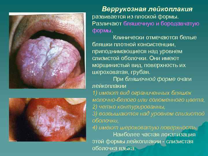 Веррукозная лейкоплакия развивается из плоской формы. Различают бляшечную и бородавчатую формы. Клинически отмечаются белые