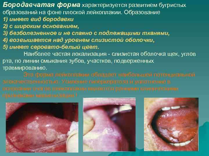 Бородавчатая форма характеризуется развитием бугристых образований на фоне плоской лейкоплакии. Образование 1) имеет вид