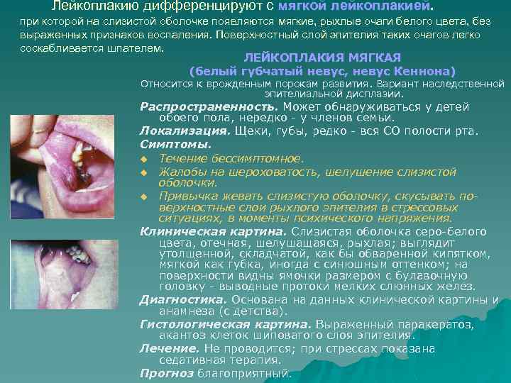 Лейкоплакию дифференцируют с мягкой лейкоплакией. при которой на слизистой оболочке появляются мягкие, рыхлые очаги