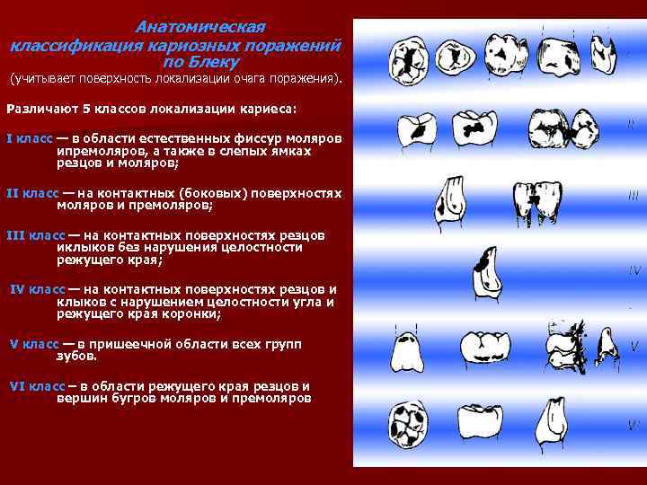 Классификация кариеса по блэку в картинках