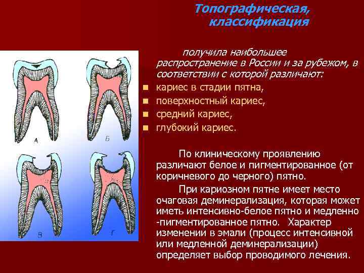 Клиническая картина среднего кариеса