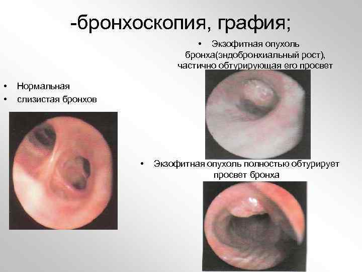-бронхоскопия, графия; • Экзофитная опухоль бронха(эндобронхиальный рост), частично обтурирующая его просвет • • Нормальная