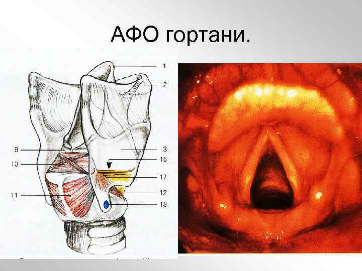АФО гортани. 
