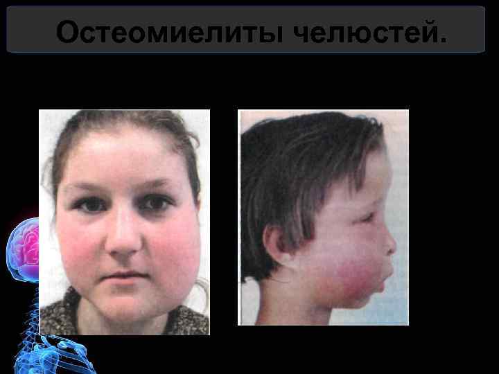 Остеомиелиты челюстей. 