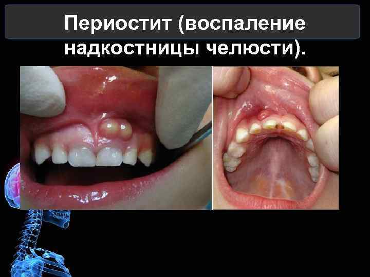 Периостит (воспаление надкостницы челюсти). 