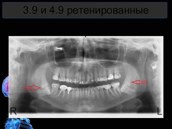 3. 9 и 4. 9 ретенированные зубы 