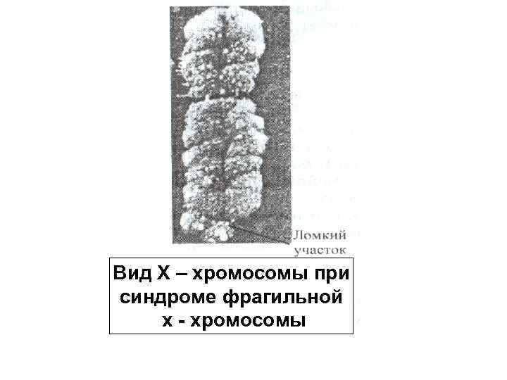 Вид Х – хромосомы при синдроме фрагильной х - хромосомы 