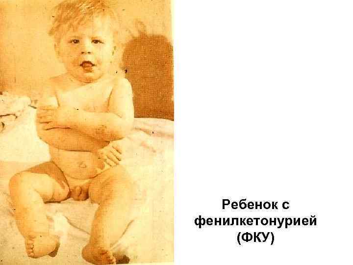 Ребенок с фенилкетонурией (ФКУ) 