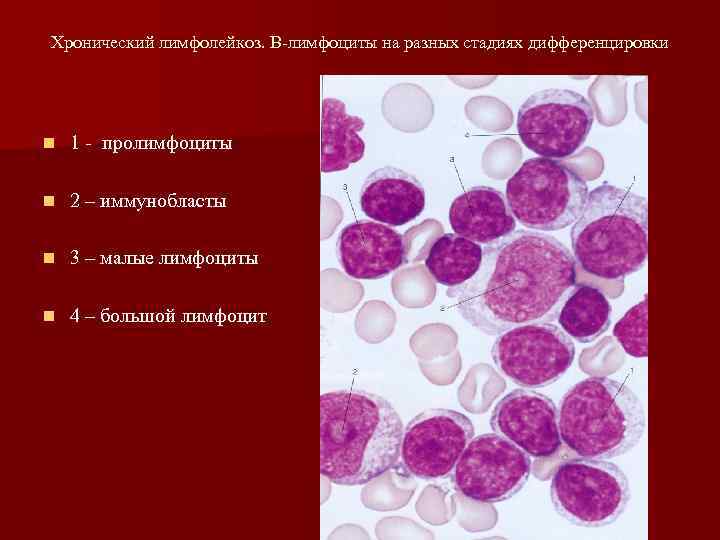 Хронический лимфолейкоз презентация