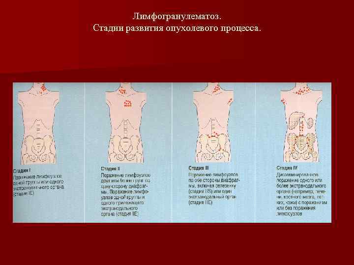 Стадии лимфом