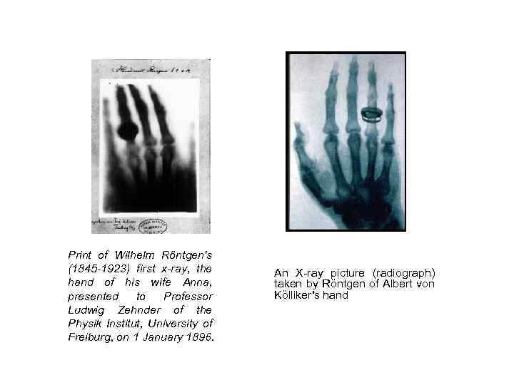 Print of Wilhelm Röntgen's (1845 -1923) first x-ray, the hand of his wife Anna,