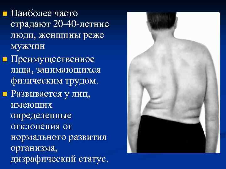 Наиболее часто страдают 20 -40 -летние люди, женщины реже мужчин n Преимущественное лица, занимающихся