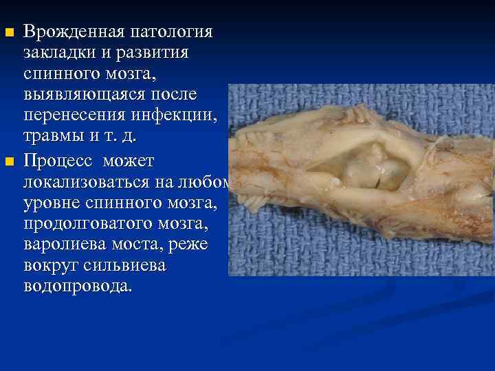 n n Врожденная патология закладки и развития спинного мозга, выявляющаяся после перенесения инфекции, травмы