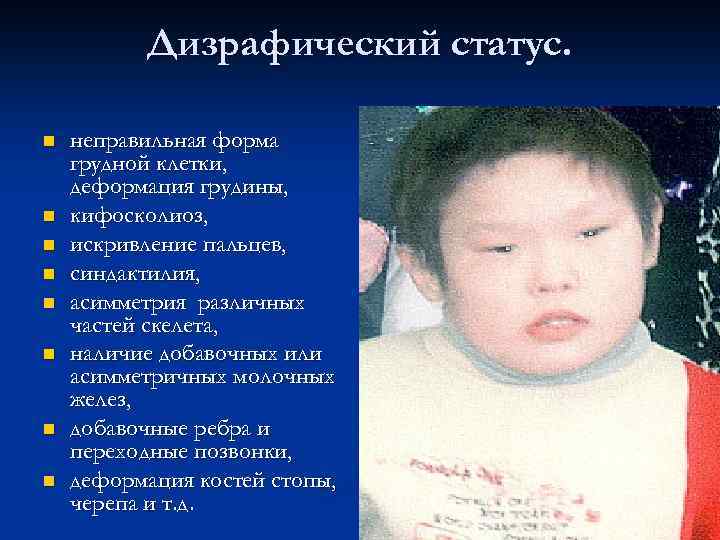 Дизрафический статус. n n n n неправильная форма грудной клетки, деформация грудины, кифосколиоз, искривление