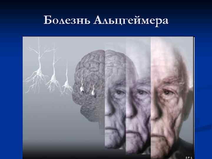 Болезнь Альцгеймера 