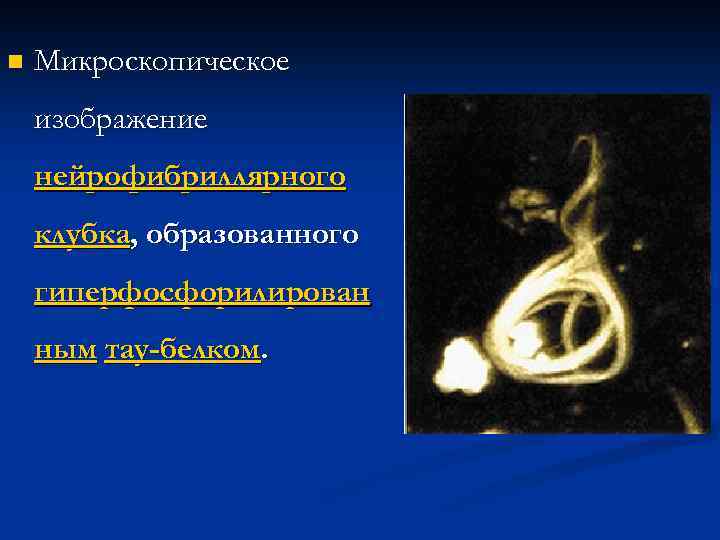 n Микроскопическое изображение нейрофибриллярного клубка, образованного гиперфосфорилирован ным тау-белком. 