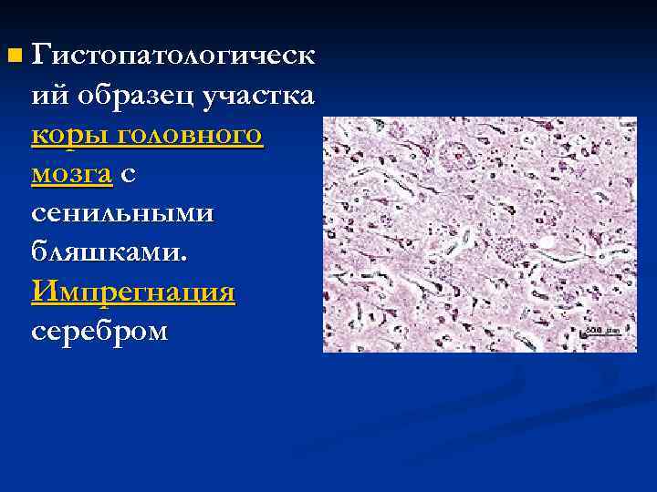 n Гистопатологическ ий образец участка коры головного мозга с сенильными бляшками. Импрегнация серебром 