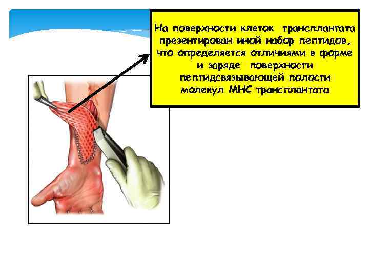 На поверхности клеток трансплантата презентирован иной набор пептидов, что определяется отличиями в форме и