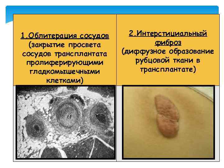 1. Облитерация сосудов (закрытие просвета сосудов трансплантата пролиферирующими гладкомышечными клетками) 2. Интерстициальный фиброз (диффузное