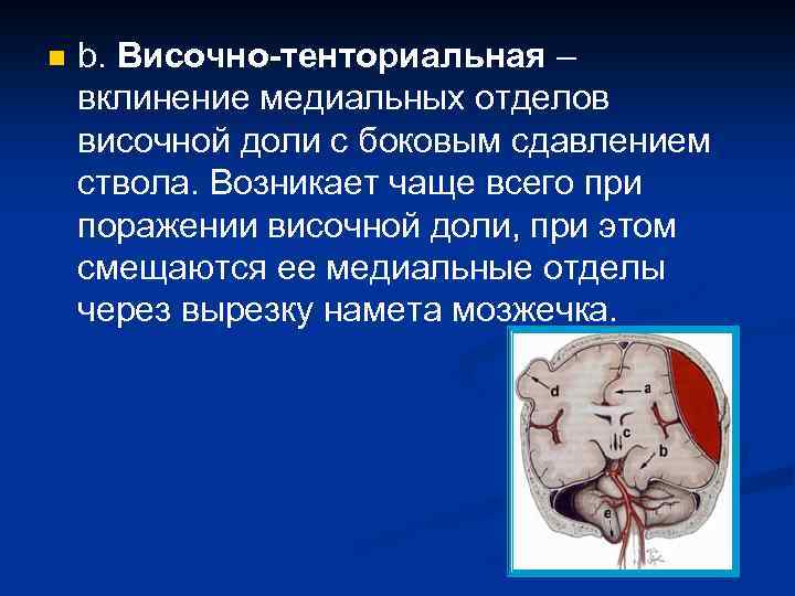 n b. Височно-тенториальная – вклинение медиальных отделов височной доли с боковым сдавлением ствола. Возникает