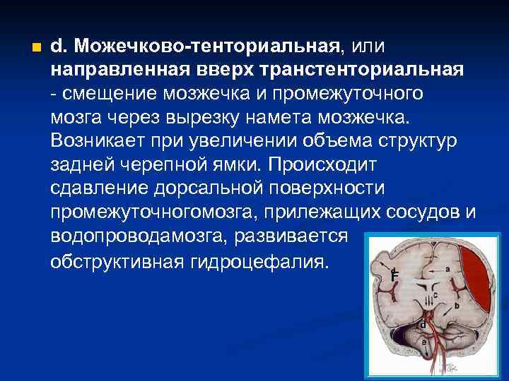 n d. Можечково-тенториальная, или направленная вверх транстенториальная - смещение мозжечка и промежуточного мозга через