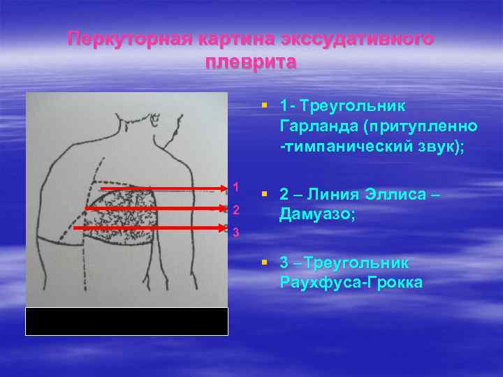 Перкуторная картина экссудативного плеврита § 1 - Треугольник Гарланда (притупленно -тимпанический звук); 1 2