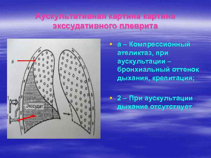 Какая аускультативная картина характерна для сухого плеврита