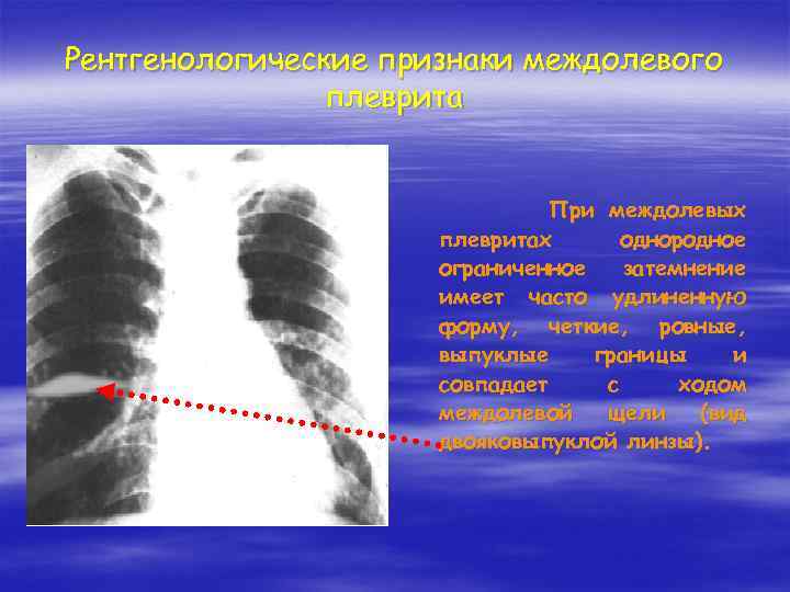 Рентгенологические признаки междолевого плеврита При междолевых плевритах однородное ограниченное затемнение имеет часто удлиненную форму,