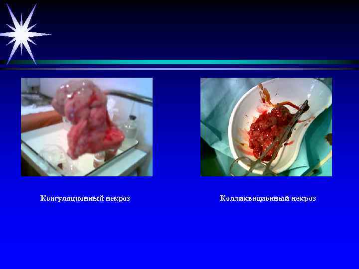Коагуляционный некроз Колликвационный некроз 