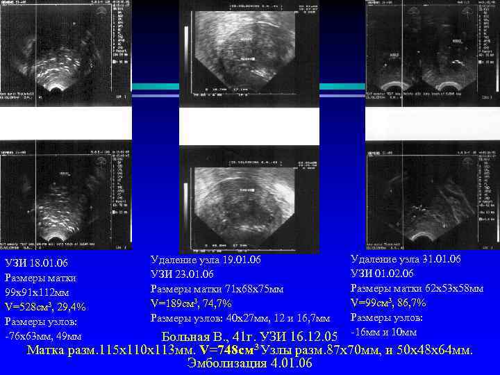Матка 50. Ширина матки по УЗИ. Расположение матки по УЗИ. Ширина матки 49мм. Норма матки по УЗИ.