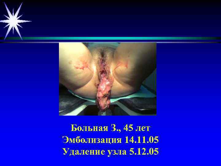 Больная З. , 45 лет Эмболизация 14. 11. 05 Удаление узла 5. 12. 05