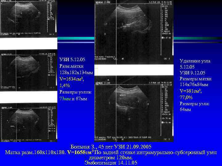 УЗИ 5. 12. 05 Разм. матки 128 х182 х134 мм V=1634 cм 3, 1,