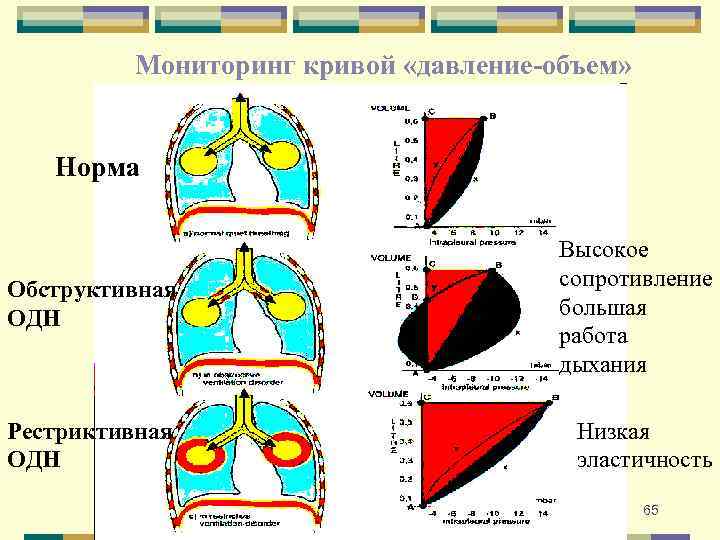 Мониторинг кривой «давление-объем» Норма Обструктивная ОДН Высокое сопротивление большая работа дыхания Рестриктивная ОДН Низкая