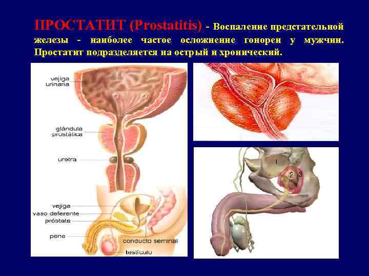 ПРОСТАТИТ (Prostatitis) - Воспаление предстательной железы - наиболее частое осложнение гонореи у мужчин. Простатит