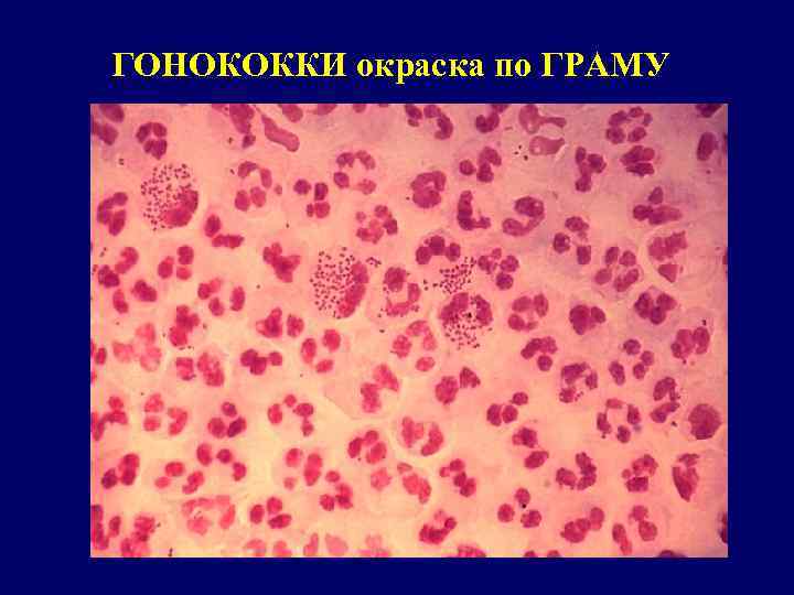 Chlamydia trachomatis neisseria gonorrhoeae. Нейссерия гонорея микробиология. Гонококк и менингококк микроскопия. Нейссерия гонорея окраска. Незавершенный фагоцитоз нейссерии гонореи.