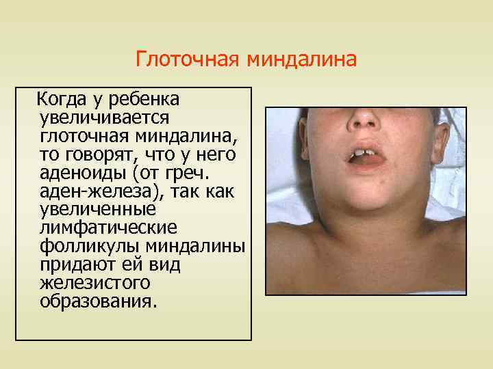 Глоточная миндалина Когда у ребенка увеличивается глоточная миндалина, то говорят, что у него аденоиды