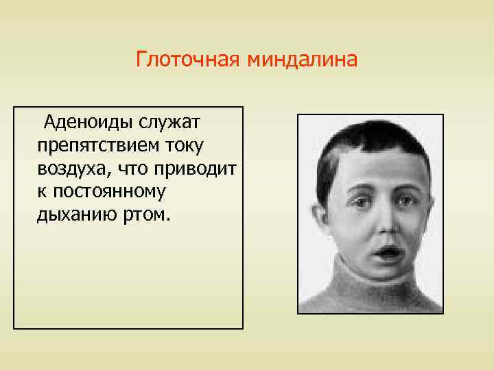 Глоточная миндалина Аденоиды служат препятствием току воздуха, что приводит к постоянному дыханию ртом. 