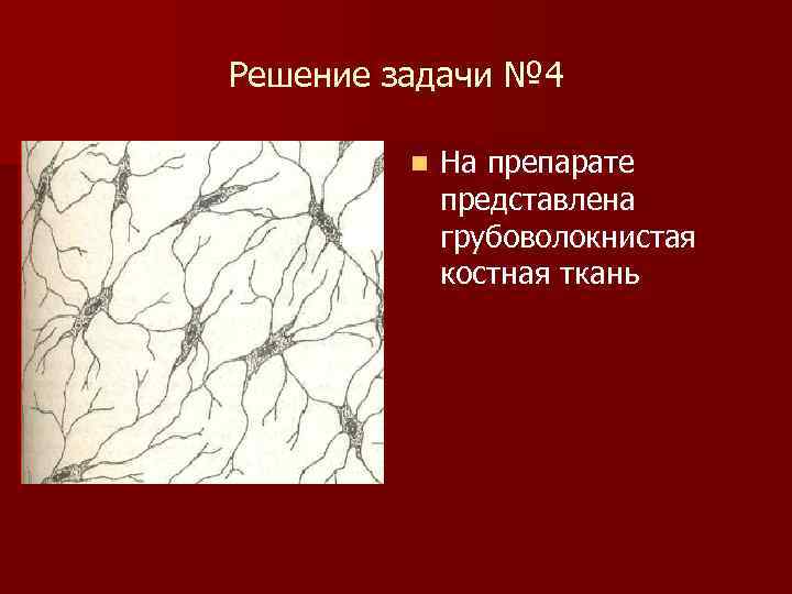 Решение задачи № 4 n На препарате представлена грубоволокнистая костная ткань 