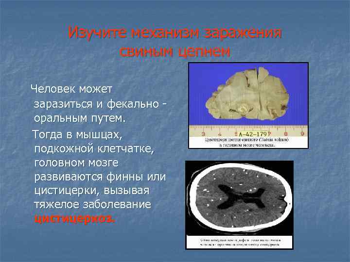 Изучите механизм заражения свиным цепнем Человек может заразиться и фекально оральным путем. Тогда в