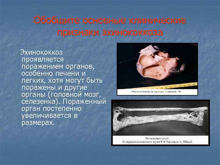 Обобщите основные клинические признаки эхинококкоза Эхинококкоз проявляется поражением органов, особенно печени и легких, хотя