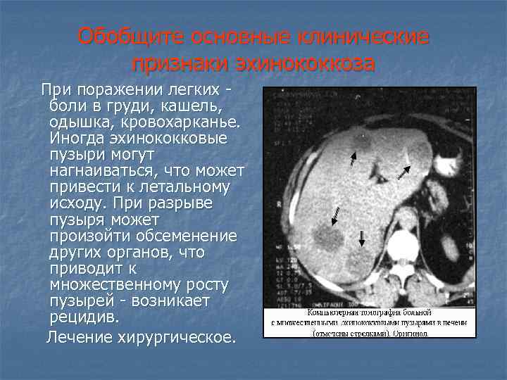 Обобщите основные клинические признаки эхинококкоза При поражении легких боли в груди, кашель, одышка, кровохарканье.