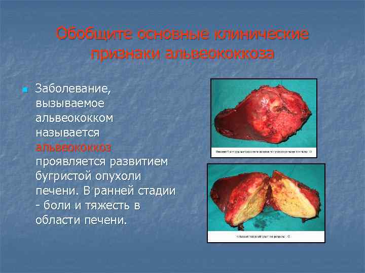 Обобщите основные клинические признаки альвеококкоза n Заболевание, вызываемое альвеококком называется альвеококкоз проявляется развитием бугристой