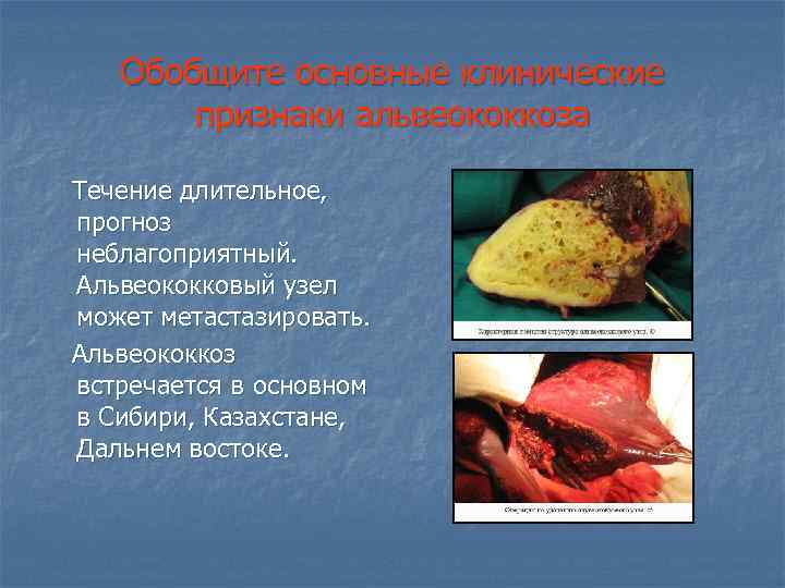 Обобщите основные клинические признаки альвеококкоза Течение длительное, прогноз неблагоприятный. Альвеококковый узел может метастазировать. Альвеококкоз