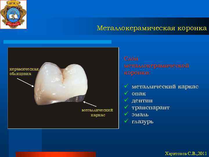 Металлокерамическая коронка Слои металлокерамической коронки: керамическая облицовка металлический каркас ü ü ü металлический каркас